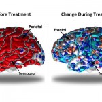 Депрессия утолщает кору головного мозга — ученые