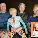 Как живется альбиносам в ЮАР